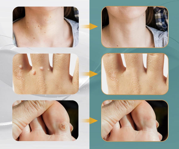 Gentle Wart & Skin Tag Solution
