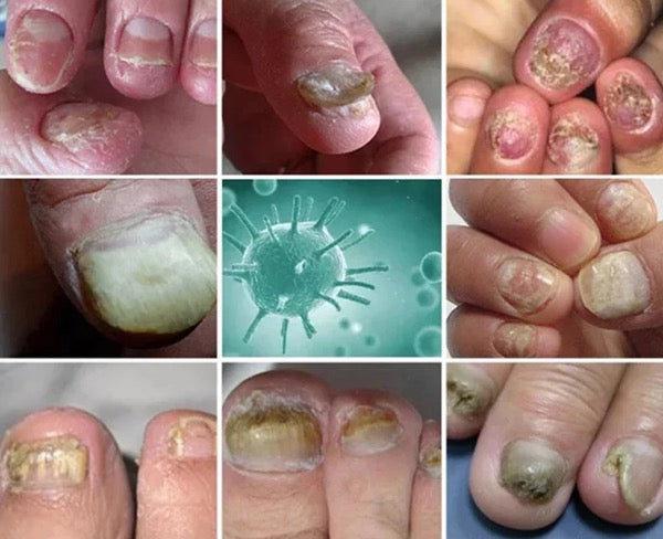 Fungus-Free Nail Solution