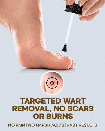 Bee Venom Wart Zapper